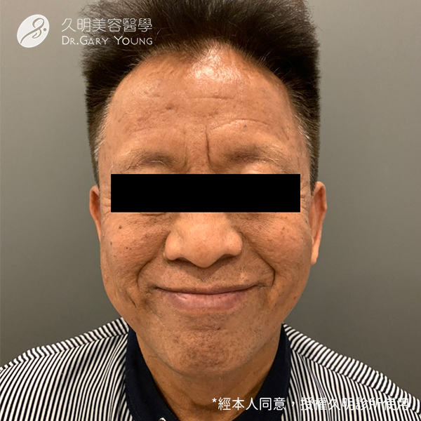 熟齡型男大改造 玻尿酸即效撫平 抬頭紋 皺眉紋 不留歲月痕跡