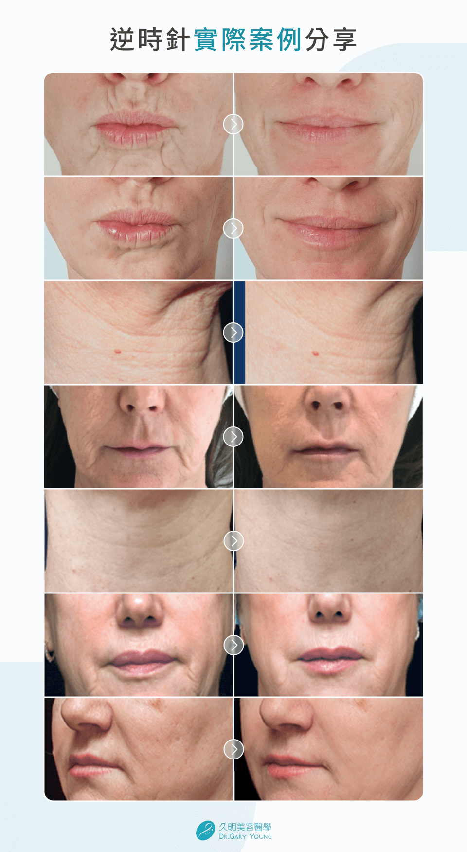 逆時針實際案例分享