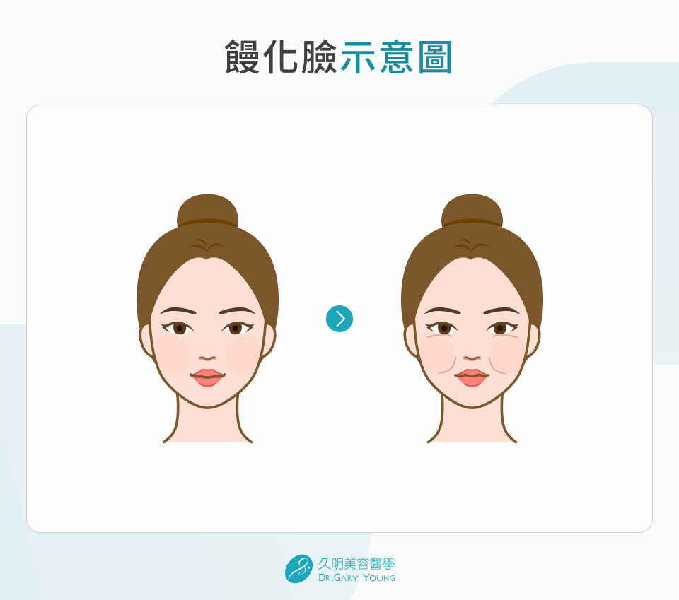 饅化是什麼？解析4大饅化成因＆5大預防原則，告別不自然臃腫！ - 久明美容