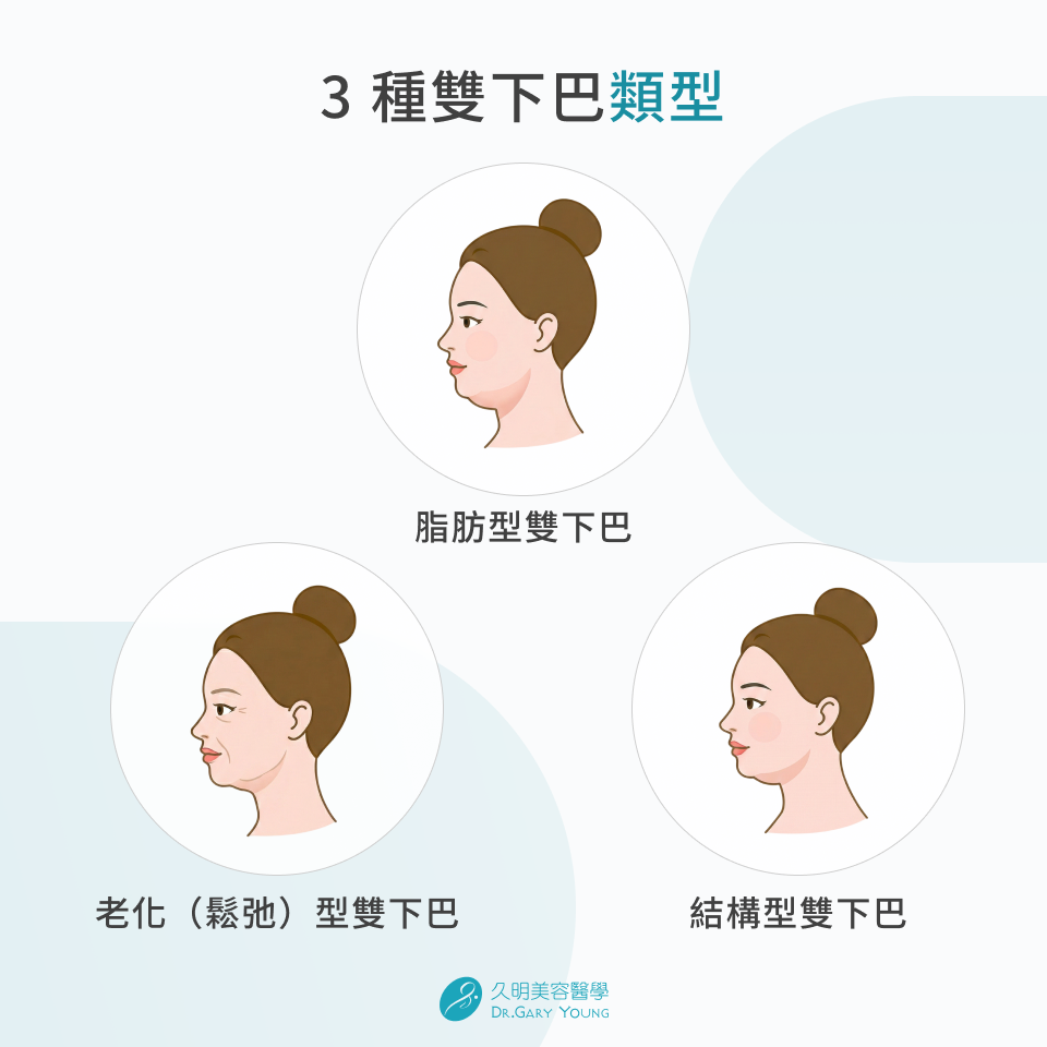 3 種雙下巴類型