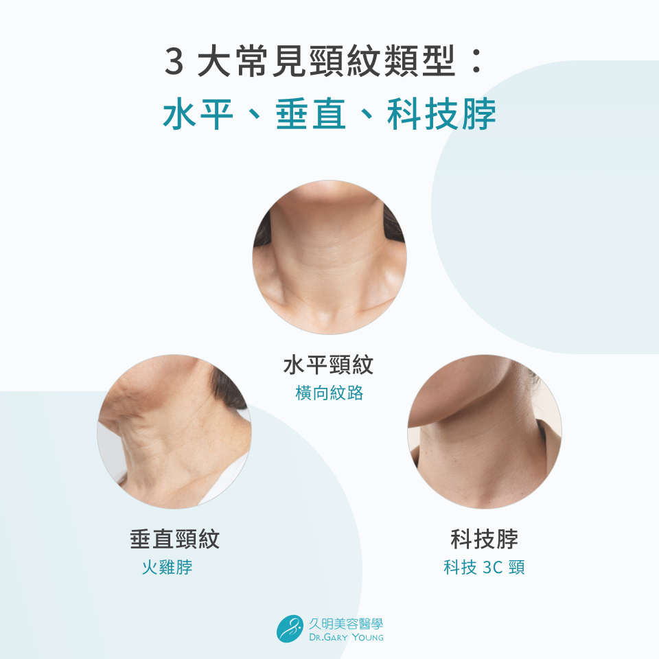 3 大常見頸紋類型
