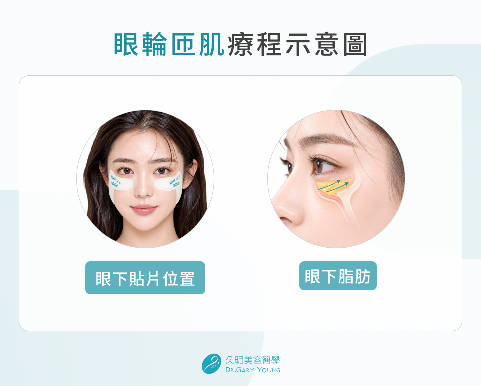 眼輪匝肌療程示意圖