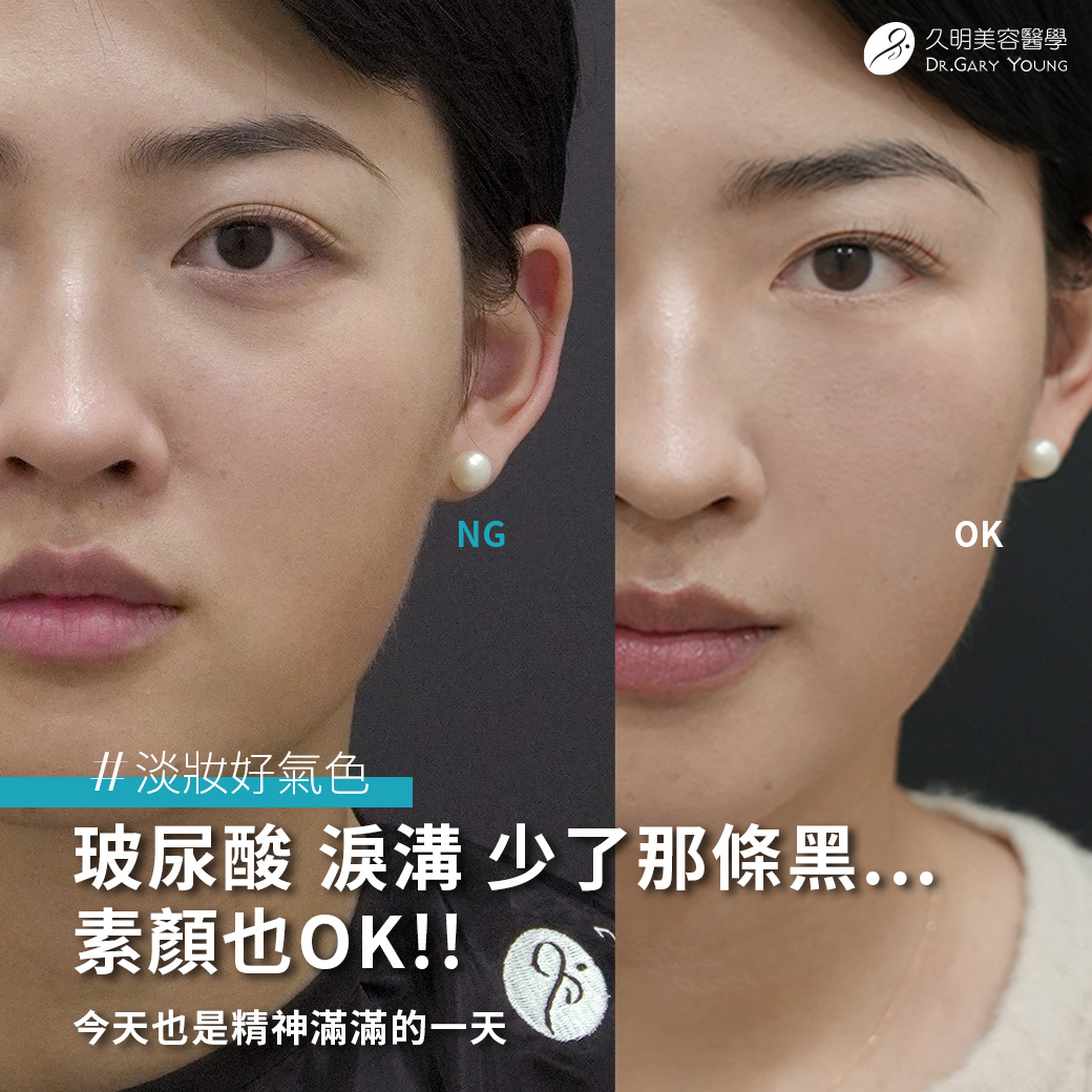 玻尿酸注射淡化淚溝